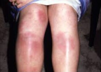 ‘Valley fever’ fungus surging northward in California