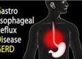 gastroesophageal reflux disease
