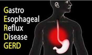 gastroesophageal reflux disease